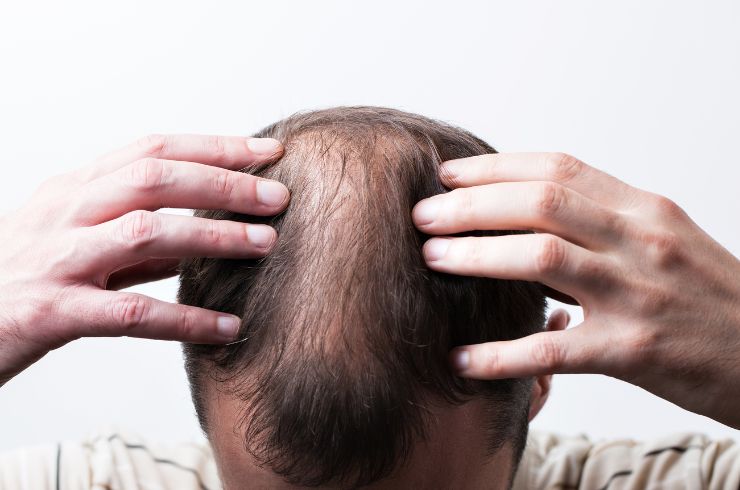 Alopecia (Hair Loss)