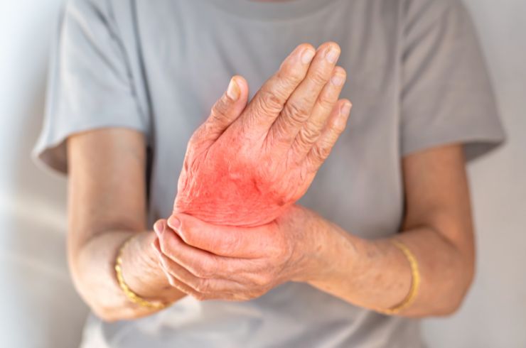 Arthritis