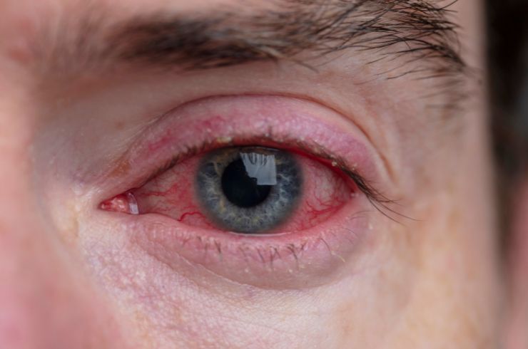 Conjunctivitis