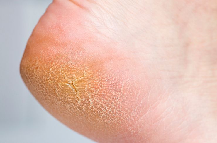 Cracked Feet