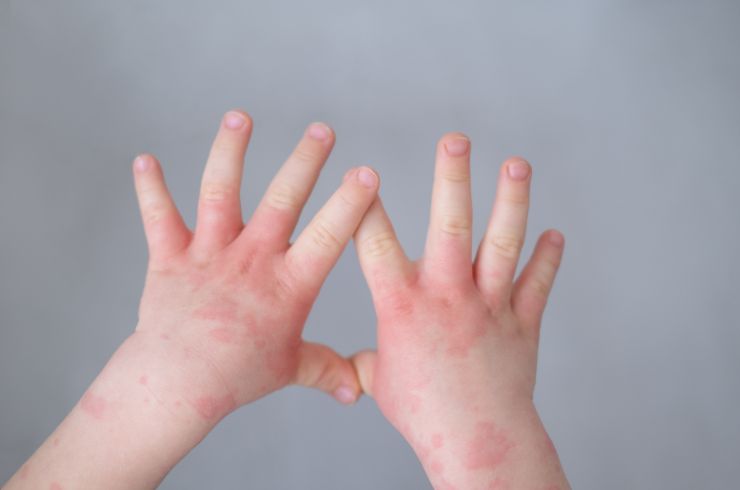 Eczema