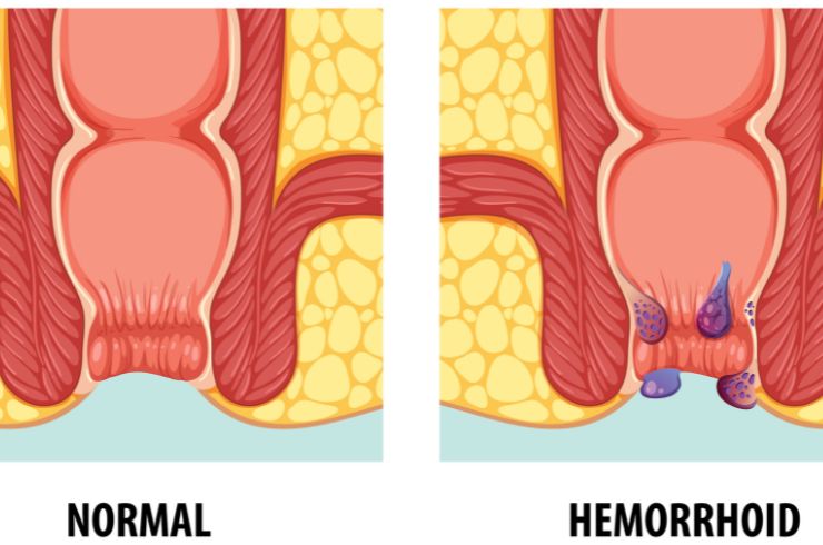 Haemorrhoids (Piles)