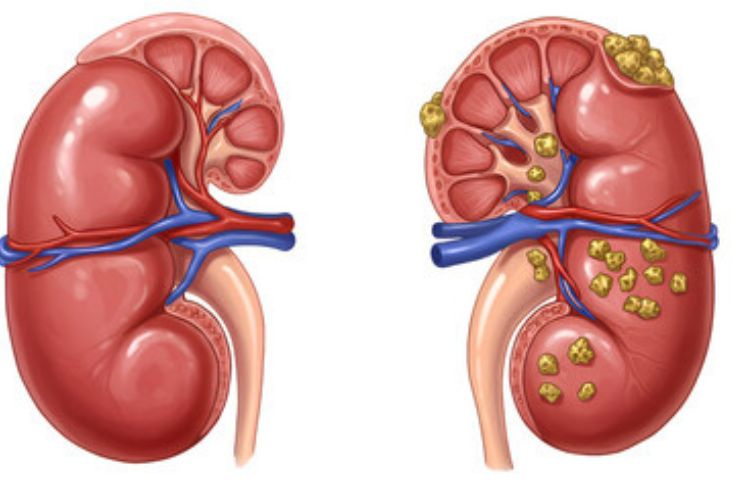 Kidney Stones
