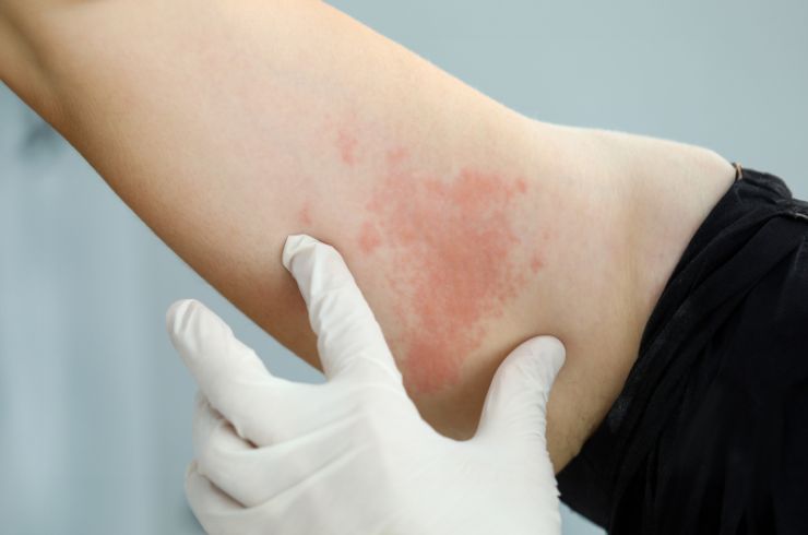 Urticaria (Hives)
