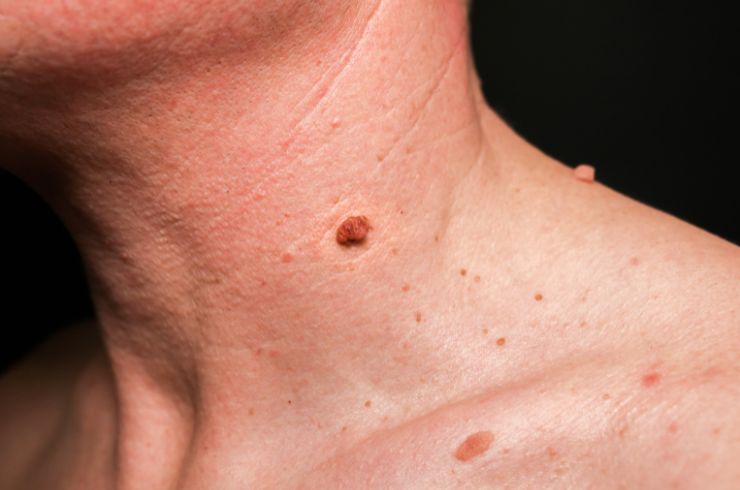 Warts